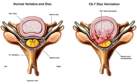 Normal Vertebra and Disc and C6-7 Disc Herniation